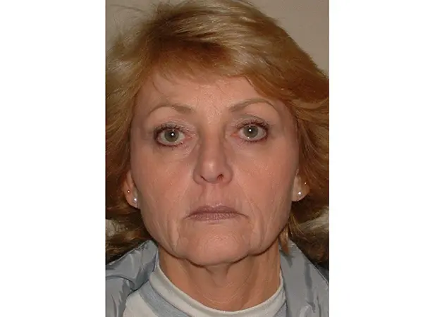 FaceLift Patient 16 Before 1