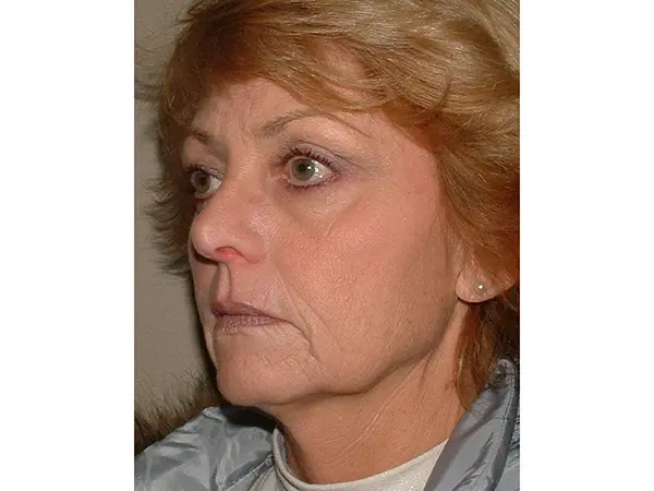 FaceLift Patient 16 Before 2