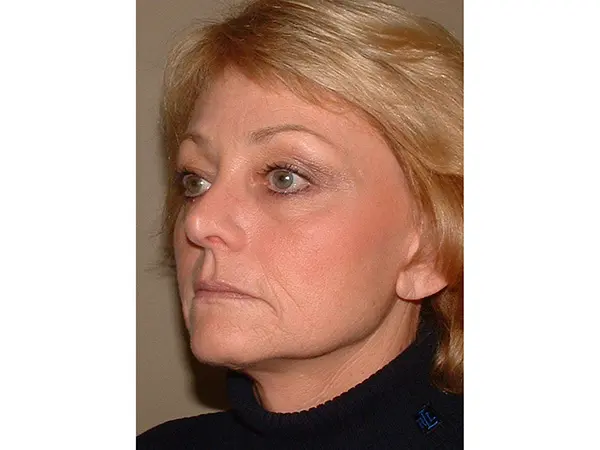 FaceLift Patient 16 After 2