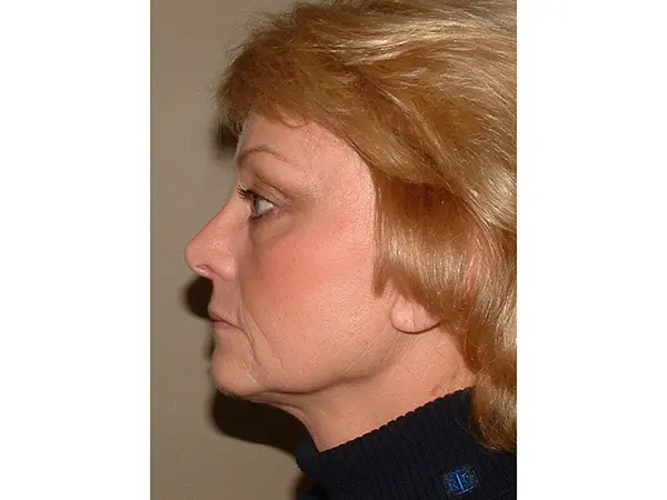 FaceLift Patient 16 After 3