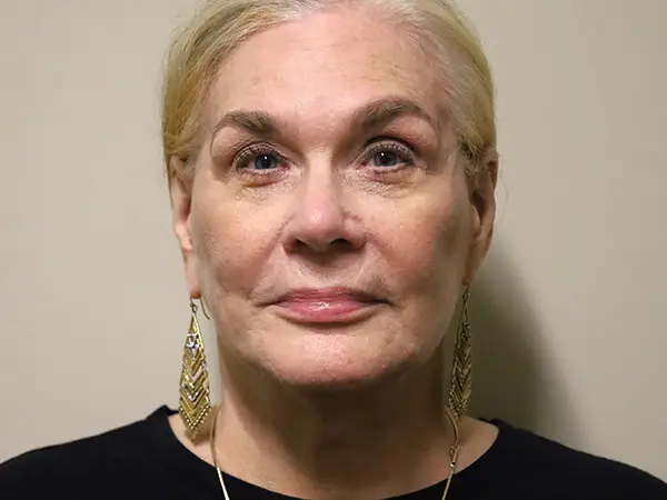 FaceLift Patient 15 After 1
