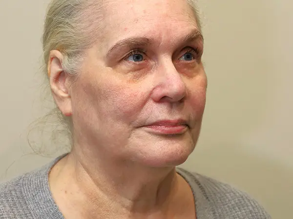 FaceLift Patient 15 Before 2