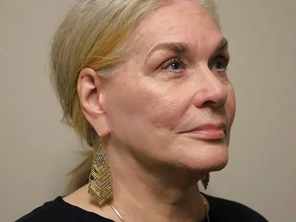 FaceLift Patient 15 After 2