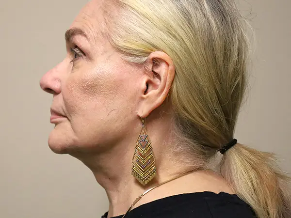 FaceLift Patient 15 After 3