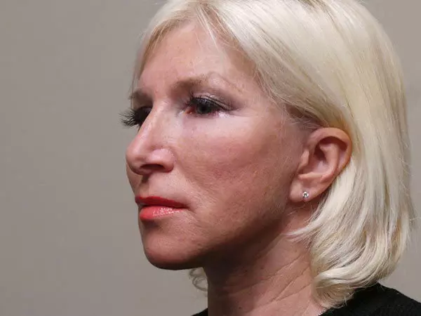 FaceLift Patient 04 After 2