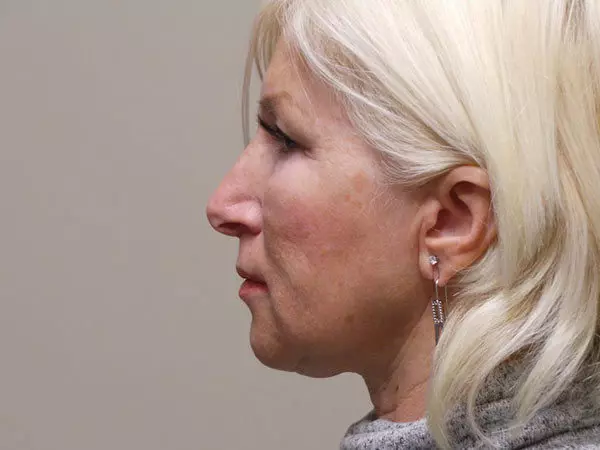 FaceLift Patient 04 Before 1