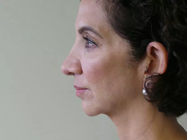 FaceLift Patient 05 After 1