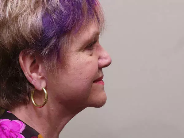 FaceLift Patient 06 After 1