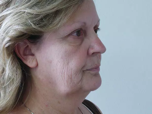 FaceLift Patient 07 Before 1