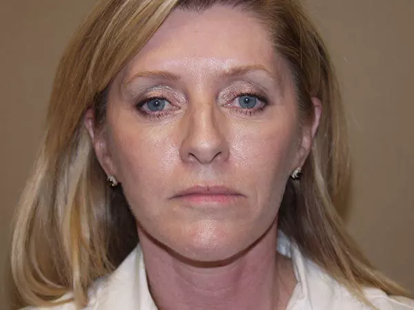 FaceLift Patient 14 After 1