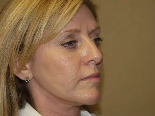 FaceLift Patient 14 After 2