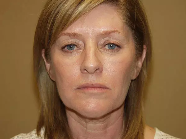 FaceLift Patient 14 Before 1