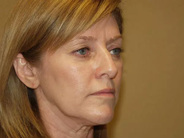 FaceLift Patient 14 Before 2