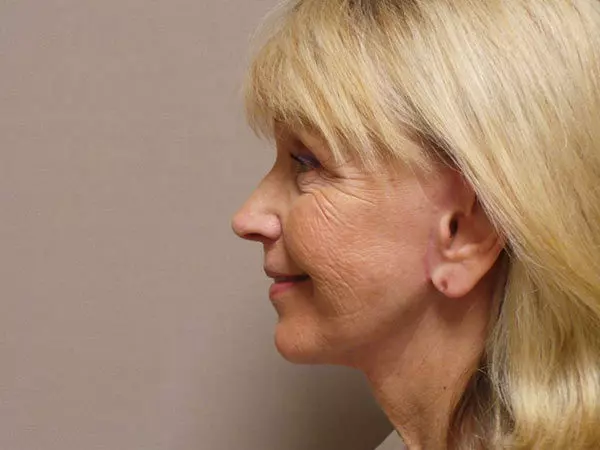 FaceLift Patient 13 After 1