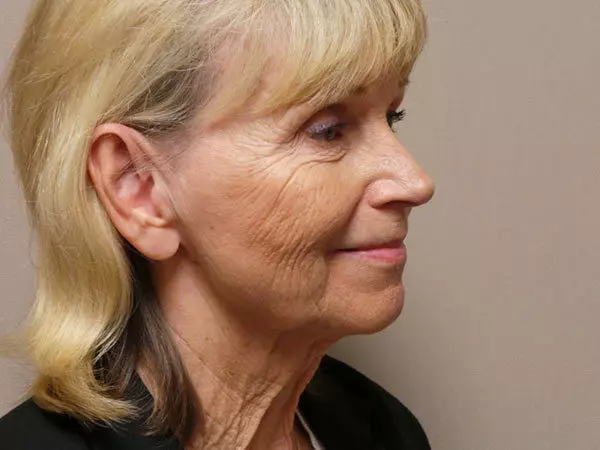 FaceLift Patient 13 Before 2