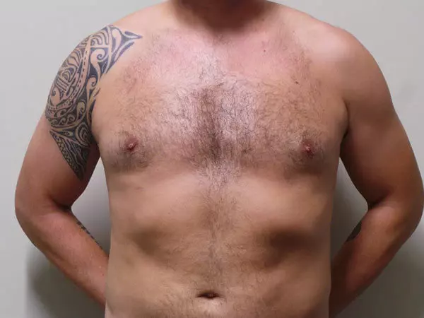 Gynecomastia Patient 01 After 1