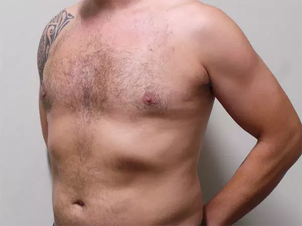 Gynecomastia Patient 01 After 2