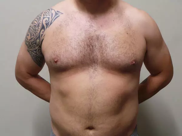 Gynecomastia Patient 01 Before 1