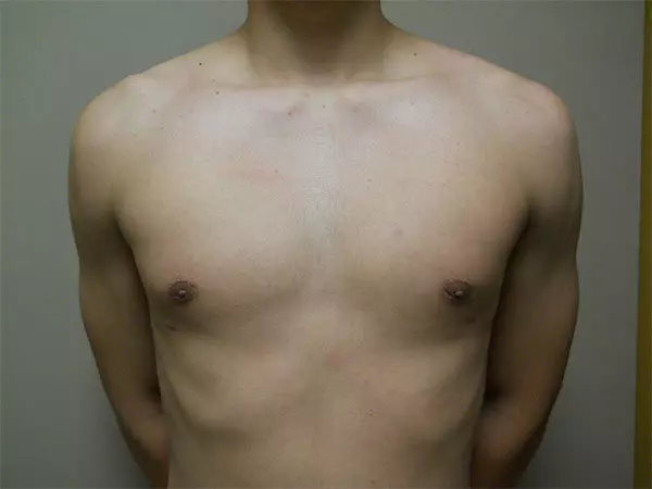 Gynecomastia Patient 09 After 1
