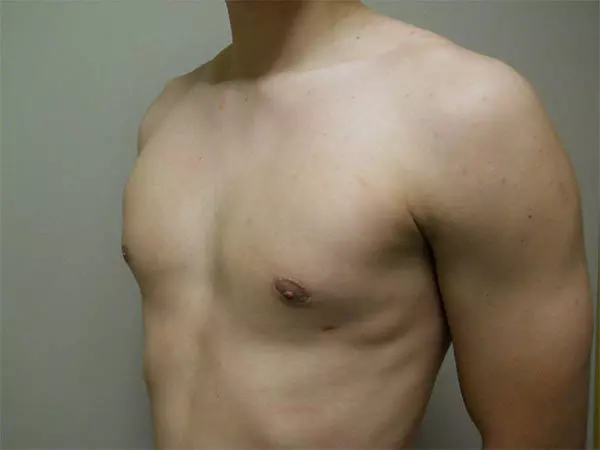 Gynecomastia Patient 09 After 2