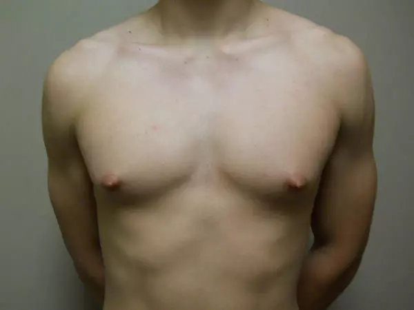 Gynecomastia Patient 09 Before 1