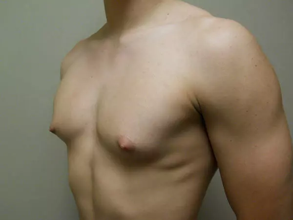 Gynecomastia Patient 09 Before 2