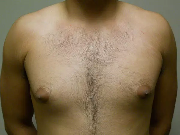 Gynecomastia Patient 11 Before 1