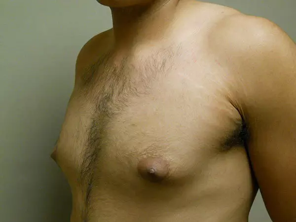 Gynecomastia Patient 11 Before 2