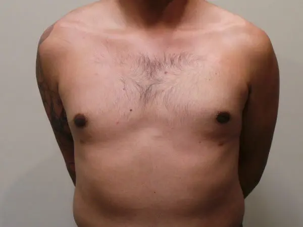 Gynecomastia Patient 06 After 1