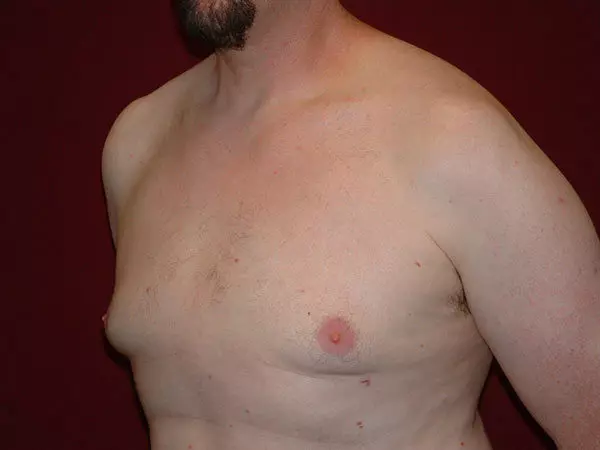 Gynecomastia Patient 04 After 2