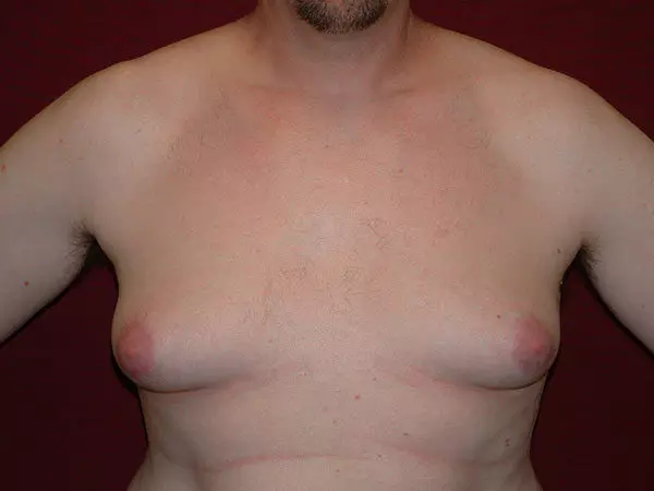 Gynecomastia Patient 04 Before 1