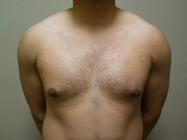 Gynecomastia Patient 05 Before 1