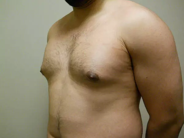 Gynecomastia Patient 05 Before 2