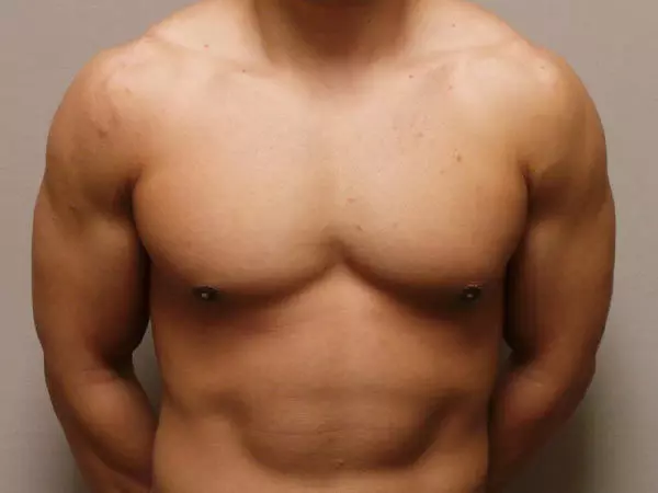 Gynecomastia Patient 07 After 1