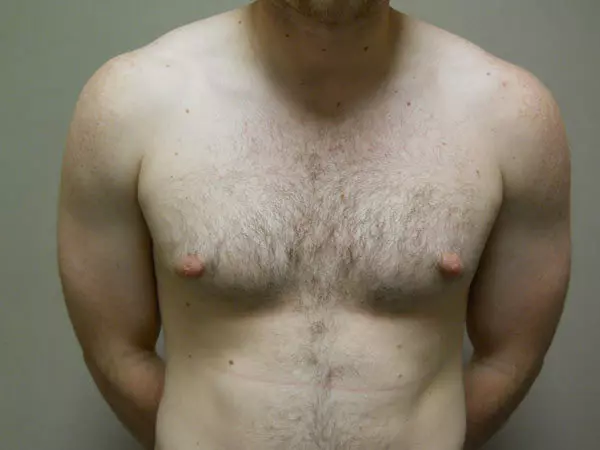 Gynecomastia Patient 08 Before 1