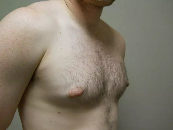 Gynecomastia Patient 08 Before 2