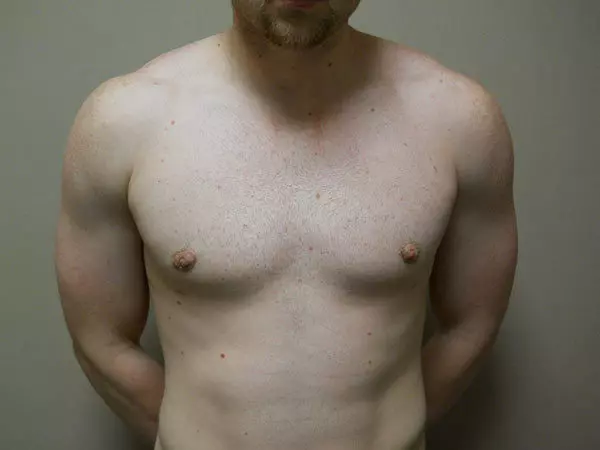 Gynecomastia Patient 08 After 1