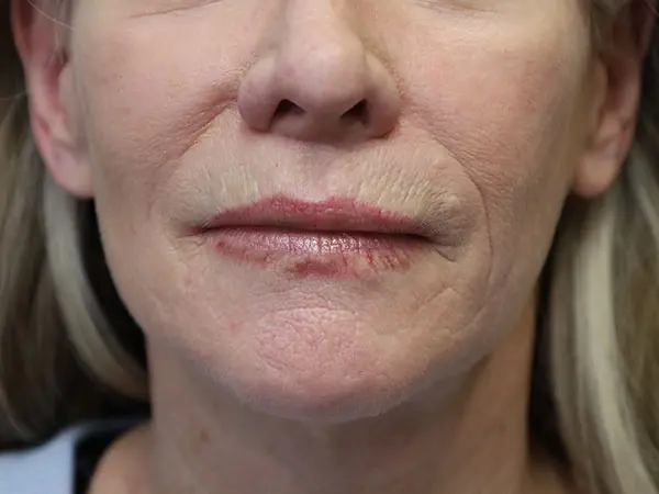 Lip Implant 01 After 1