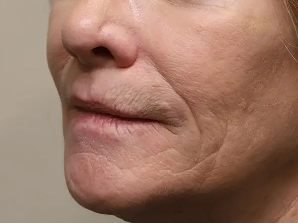 Lip Implant 01 Before 2