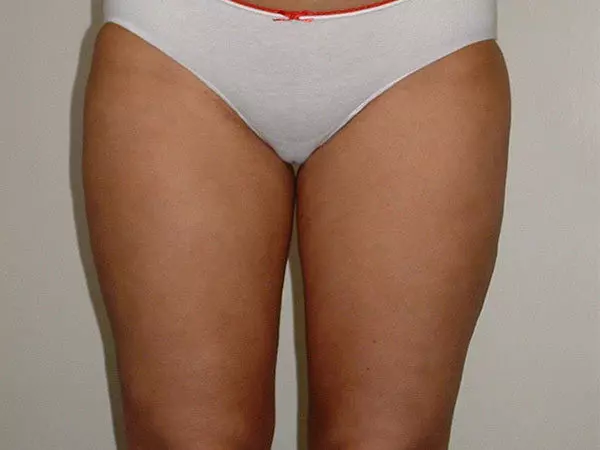 Liposuction Patient 03 After 1