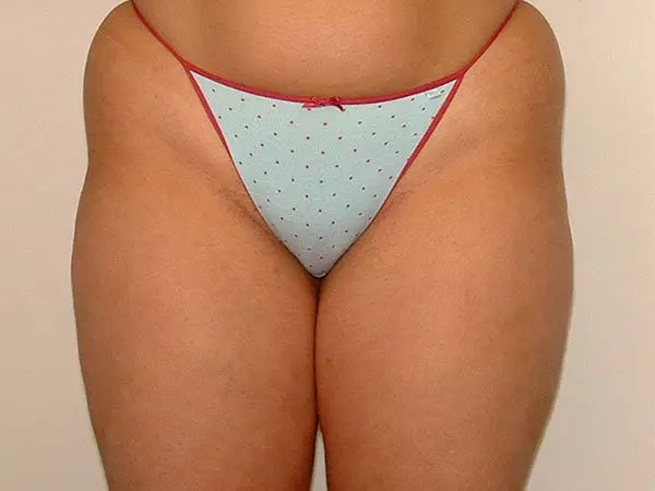 Liposuction Patient 03 Before 1