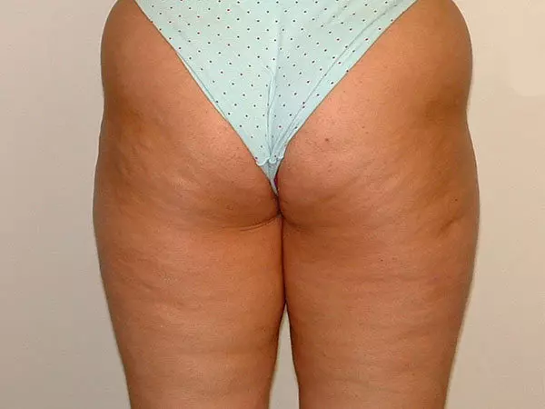 Liposuction Patient 03 Before 2