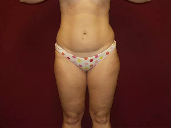 Liposuction Patient 08 Before 1