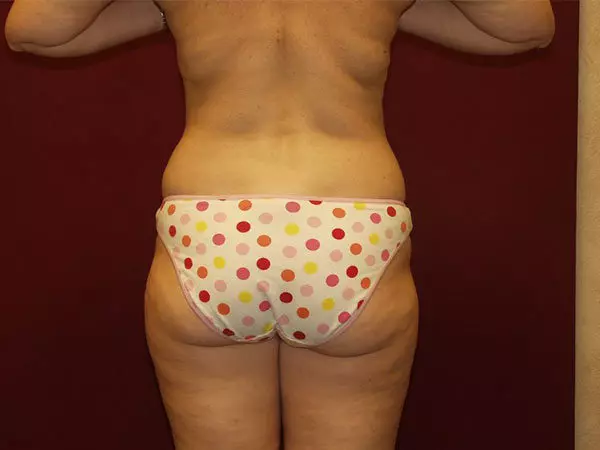 Liposuction Patient 08 Before 2