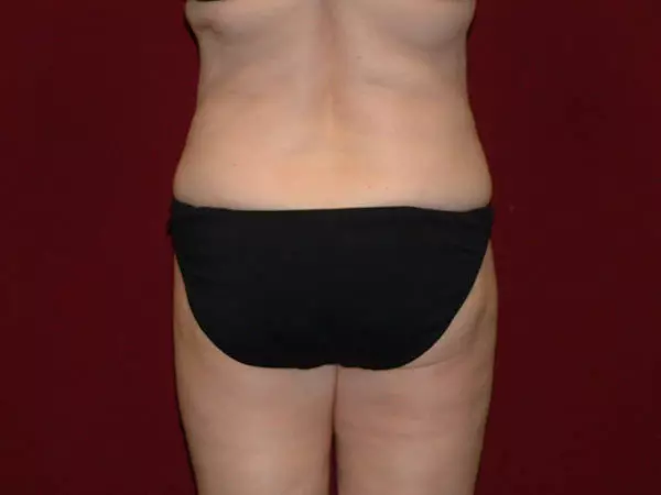 Liposuction Patient 07 After 1