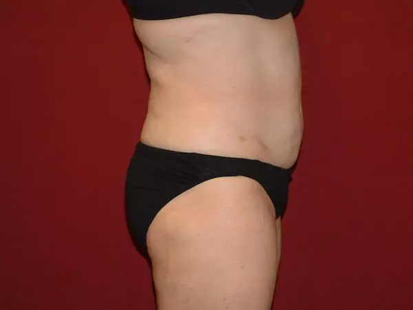 Liposuction Patient 07 After 2