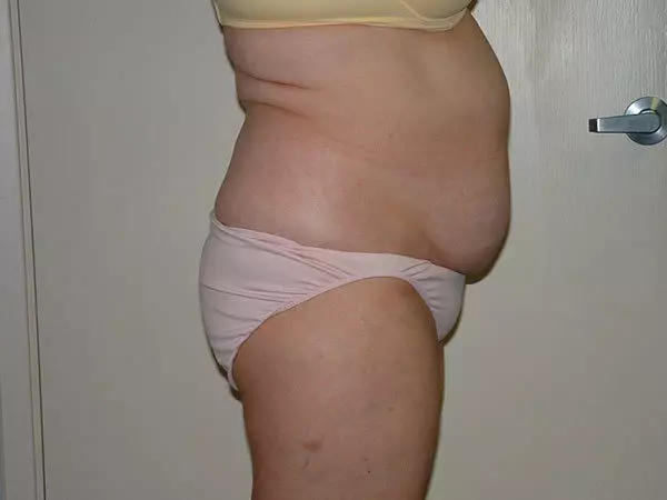 Liposuction Patient 07 Before 2