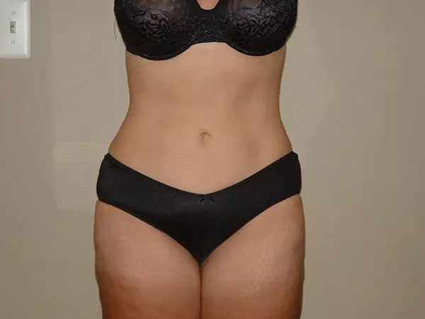 Liposuction Patient 05 After 1