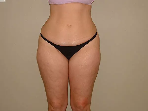 Liposuction Patient 05 Before 1