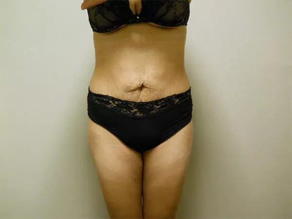 Liposuction Patient 06 After 1